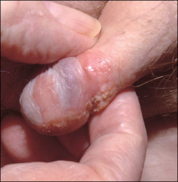 cancer of the penis Piercing my moms pussy